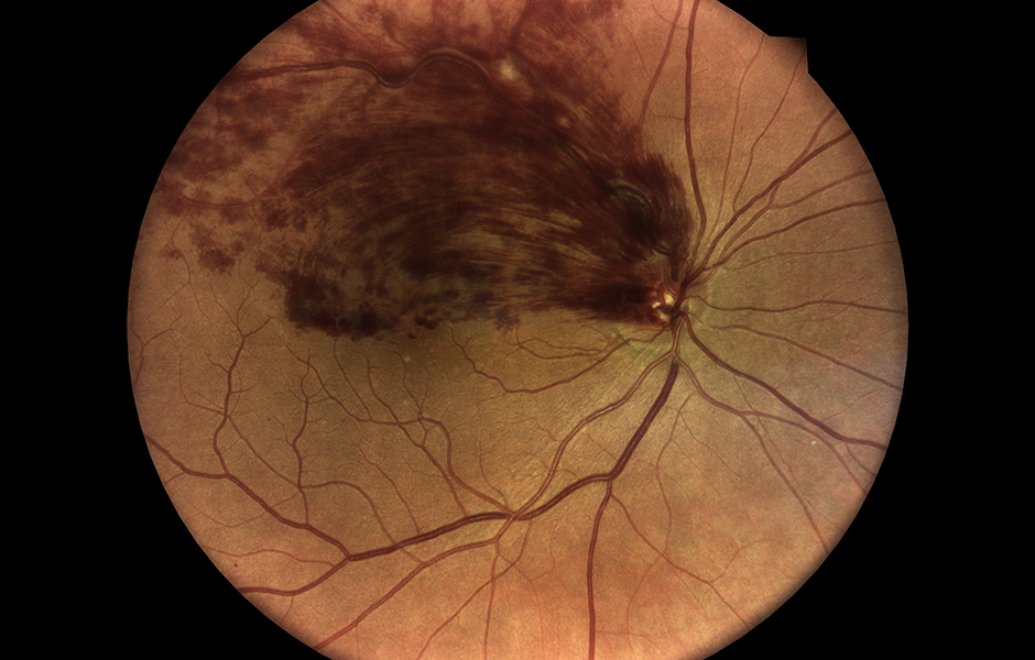 Retina scan showing Retinal Vein Occlusion