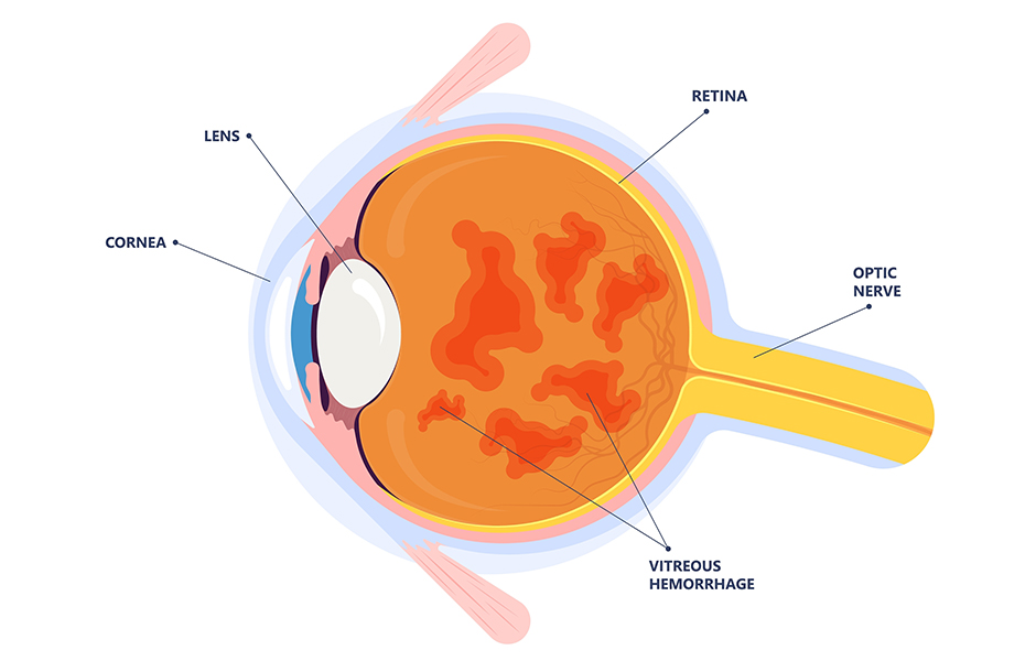 Vitreous Hemorrhages