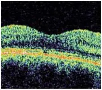 After Macular Hole Surgery