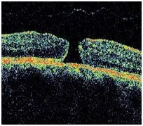 Before Macular Hole Surgery