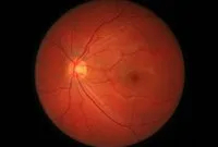 Macular Holes: How They Are Caused and Treated