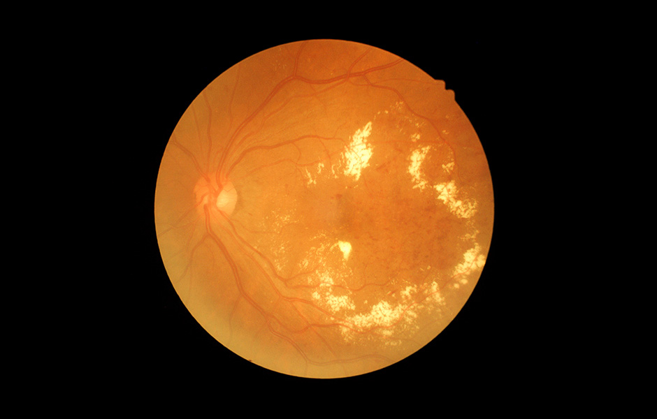 Retina of diabetic - diabetes retinopathy