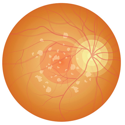 Medical illustration of the retina with dry macular degeneration