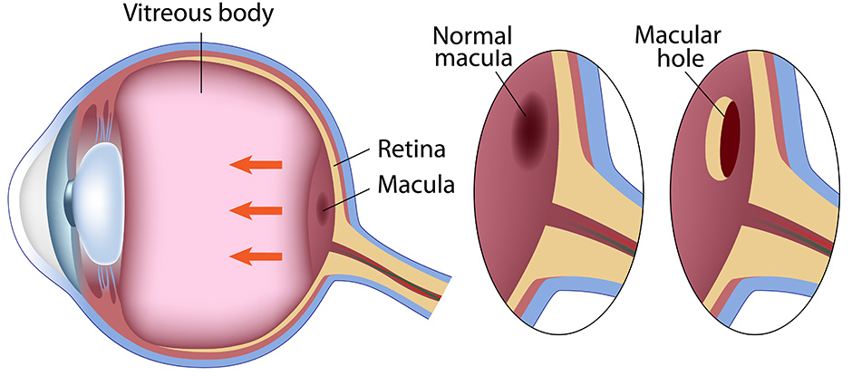 Macular hole diagram