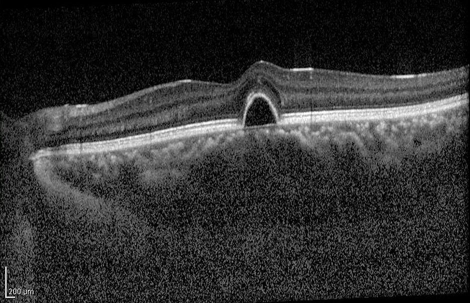 Optical Coherence Tomography (OCT) image of eye in the patient