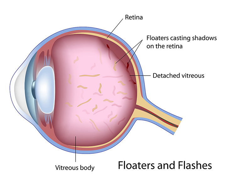 Floaters and Flashes diagram