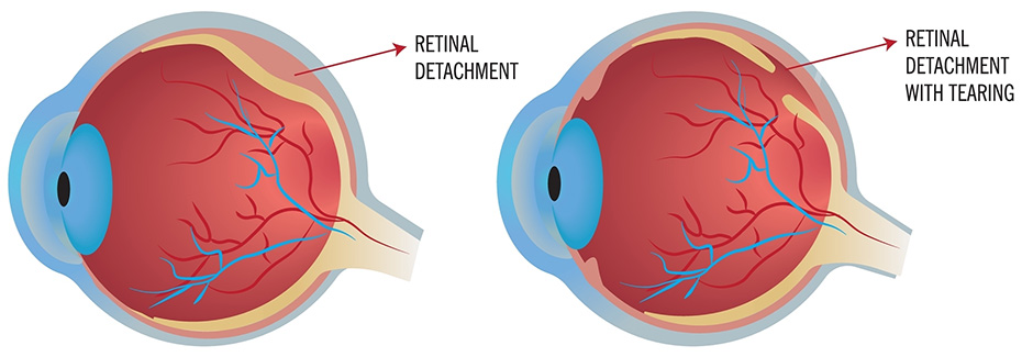 Infographic of an eye with retinal detachment, without tear.