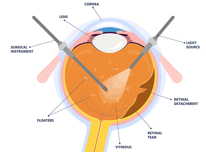 Vitrectomy Surgery