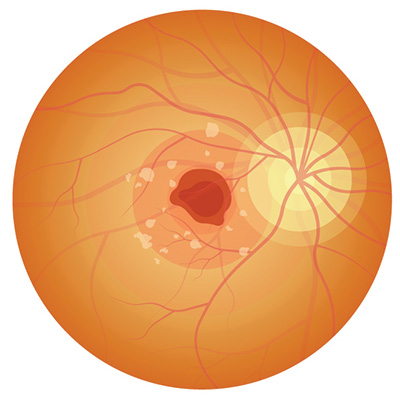 Medical illustration of the retina with wet macular degeneration